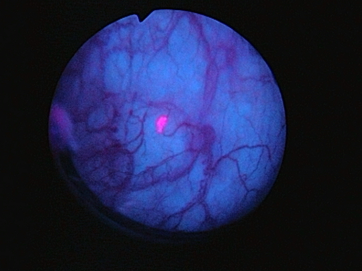 Urinblåsa med tumör sedd med blått ljus